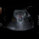 Repair of inguinal hernia, hematoma, mimic of recurrence: US - Ultrasound